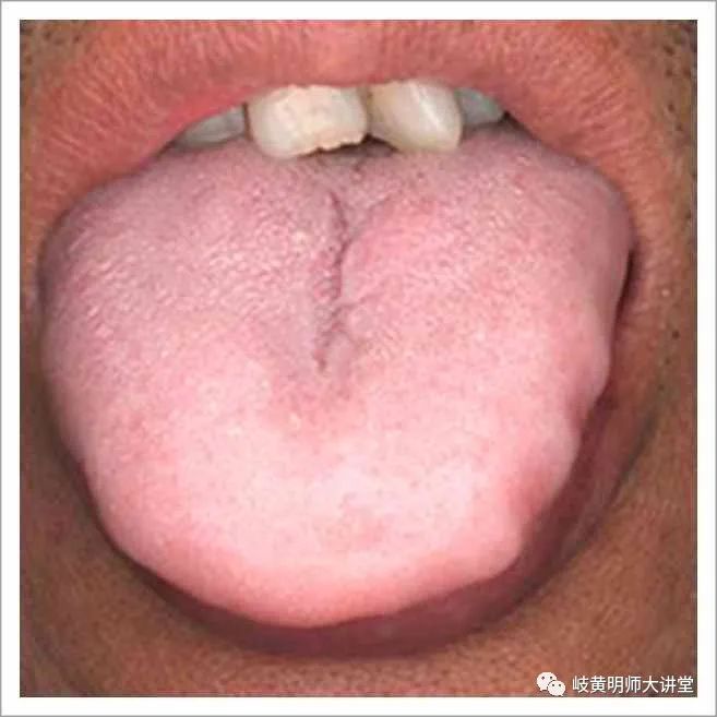 Traditional Chinese Medicine Tongue Diagnosis: Illustrated Guide to 14 Types of Tongue Shapes and Qualities