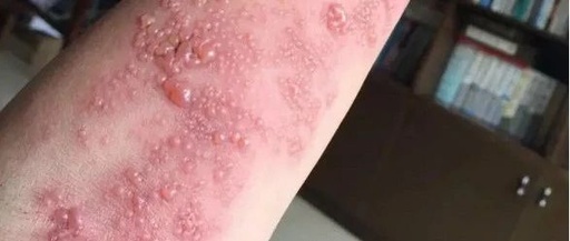 The Miraculous Effects of Moxibustion: Apparent Worsening of Symptoms Indicates Improvement!