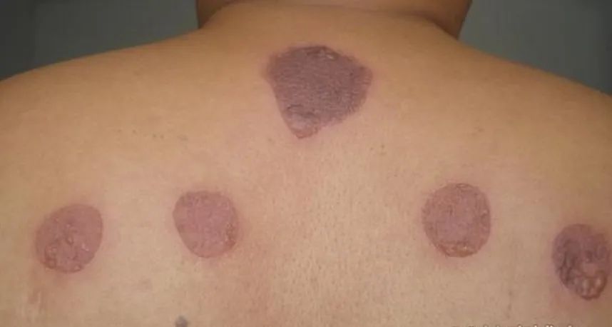 What Are the Classifications of Moxibustion?