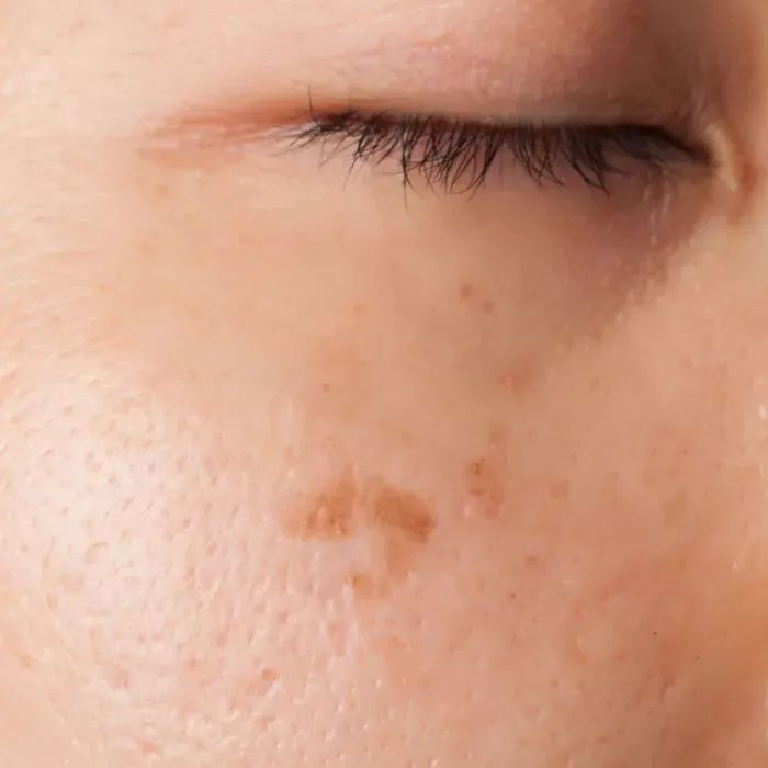Moxibustion: A Quick Way to Lift Sagging Faces!