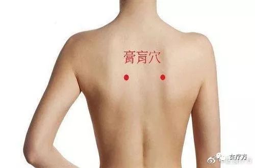 Comprehensive Guide to Cupping Therapy for the Back