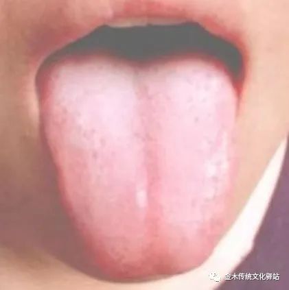 Tongue Diagnosis in Traditional Chinese Medicine: Tongue Coating