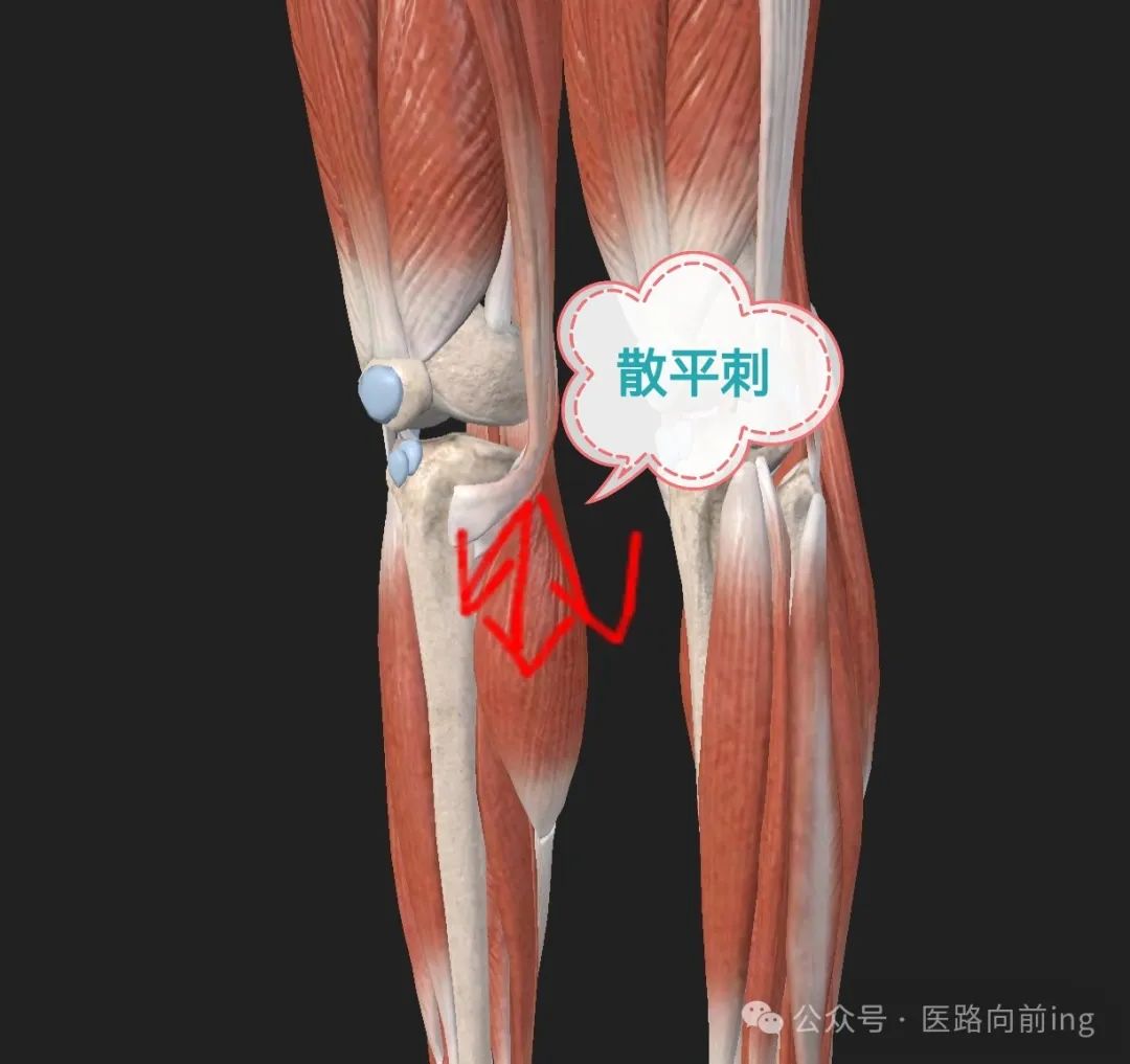 Relief from Medial Knee Pain: A Case Study of Acupuncture Treatment