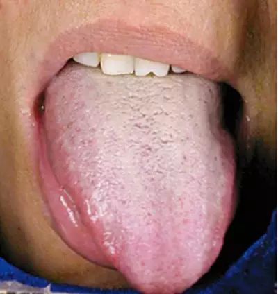 Blood Stasis and Its Impact on Health: How to Care for Individuals with Blood Stasis Constitution