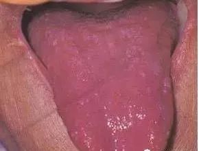 Understanding Tongue Diagnosis in Traditional Chinese Medicine (with Tongue Diagnosis Illustrations)