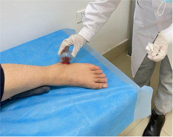 Traditional Chinese Medicine Therapy: Bloodletting Therapy