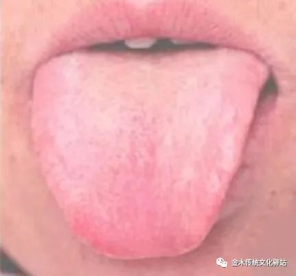 Tongue Diagnosis in Traditional Chinese Medicine: Tongue Coating