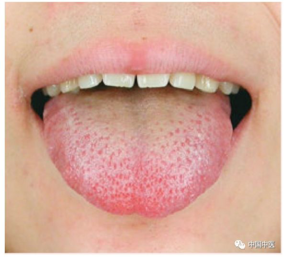 What Does the Tongue of a Phlegm-Damp Constitution Look Like in Traditional Chinese Medicine?