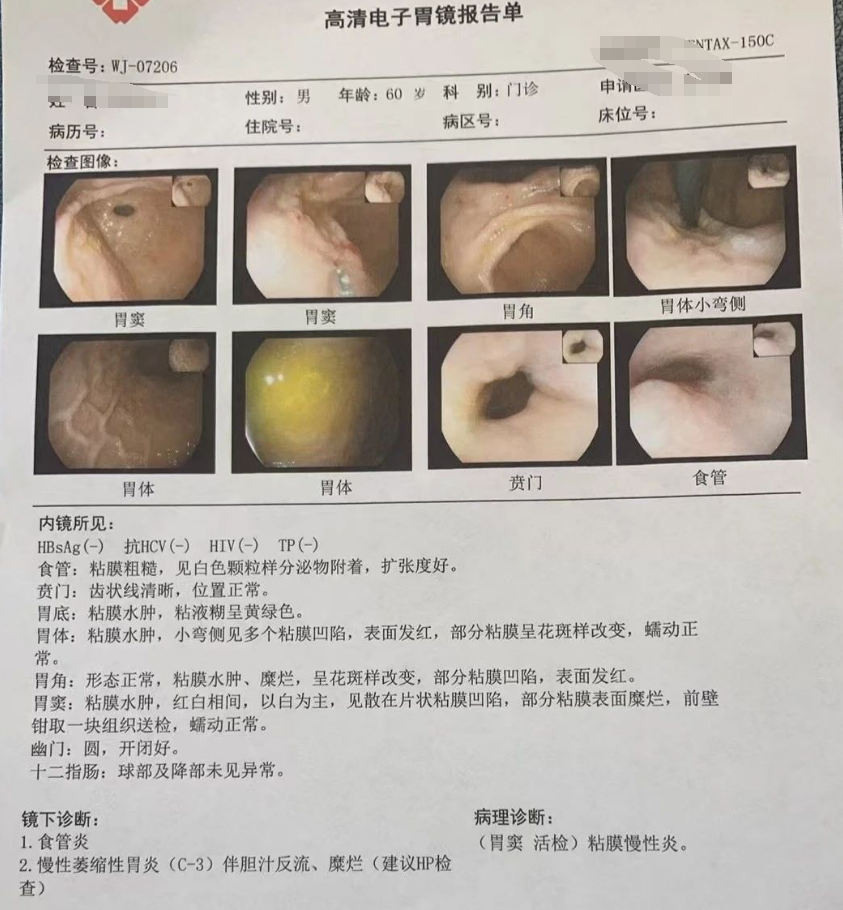 Zhang Litiao: Soothe the Liver and Relieve Depression, Harmonize the Stomach and Descend Rebellious Qi - A Case Study of Atrophic Gastritis