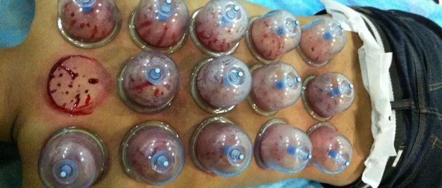 The Therapeutic Effects of Bloodletting in Traditional Chinese Medicine