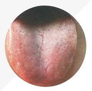 Understanding Tongue Diagnosis in TCM: Insights into Health from Tongue Appearance (Part 2)