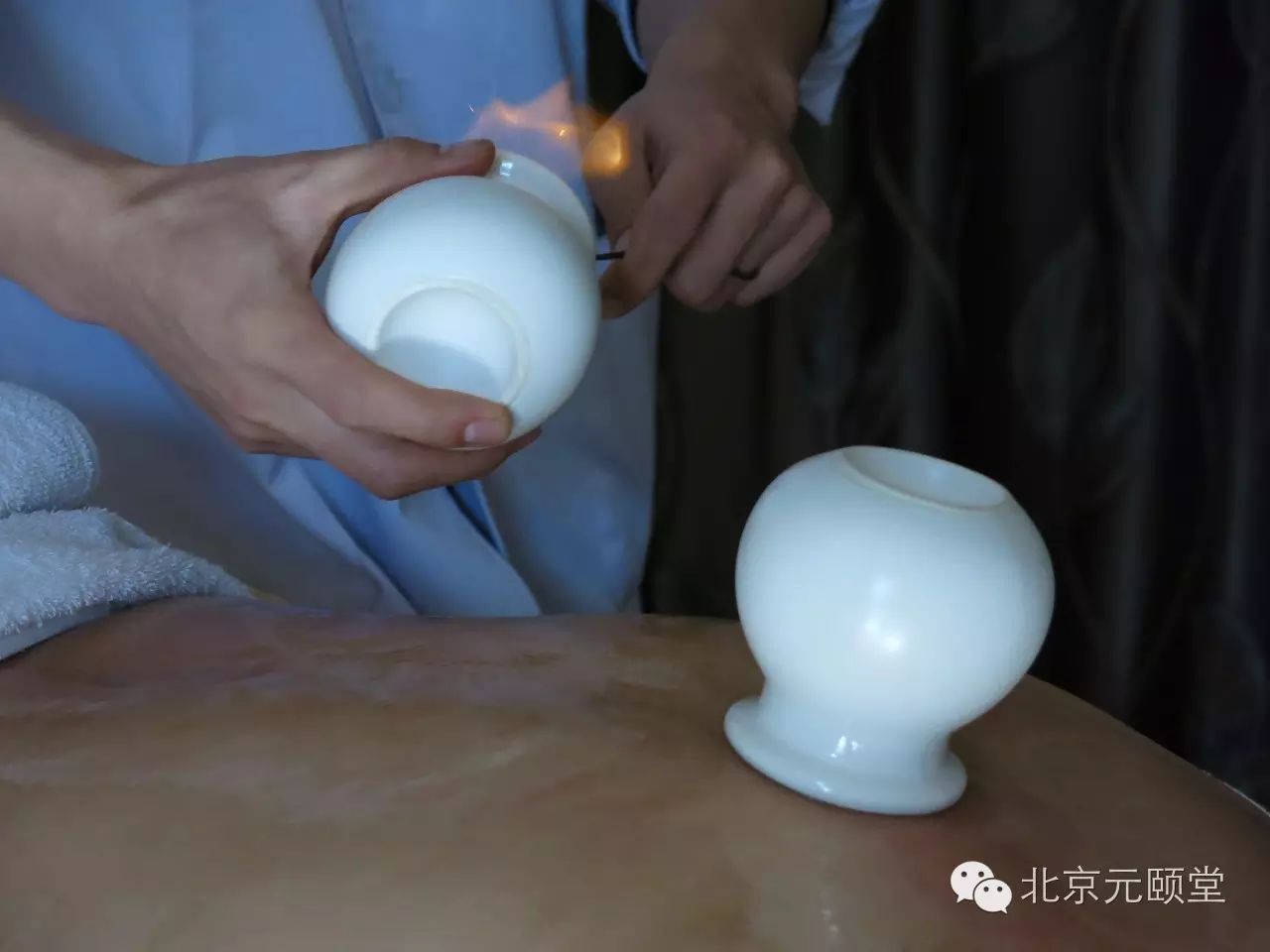 Benefits of Cupping Therapy on the Back