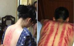 The Eight Most Common Techniques of Gua Sha and Comprehensive Analysis of Sha Patterns