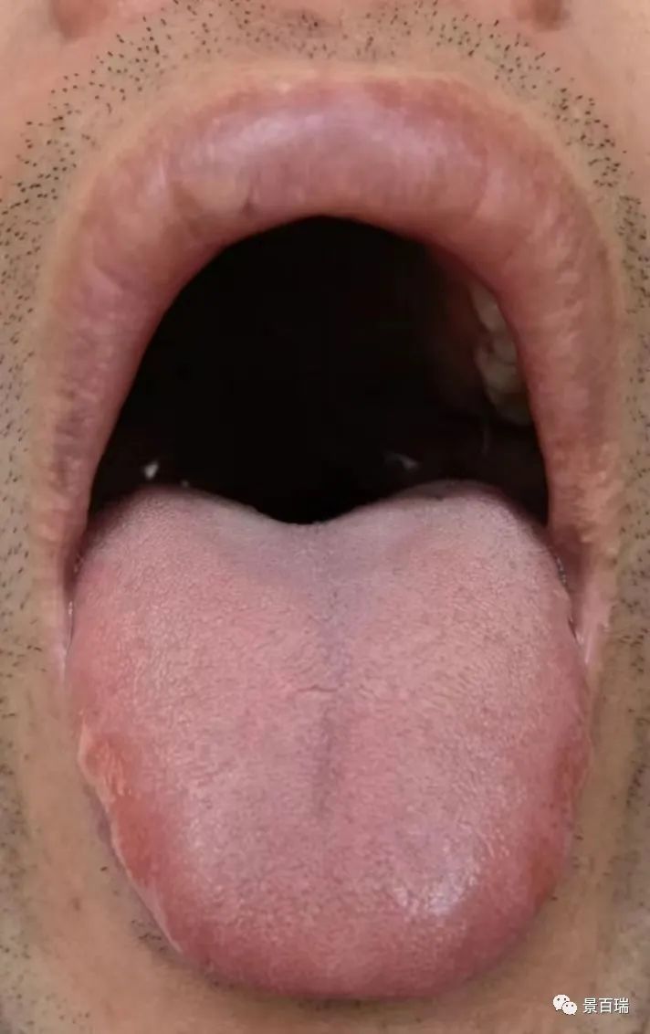 Basic Tongue Diagnosis - Tongue Body and Tongue Coating