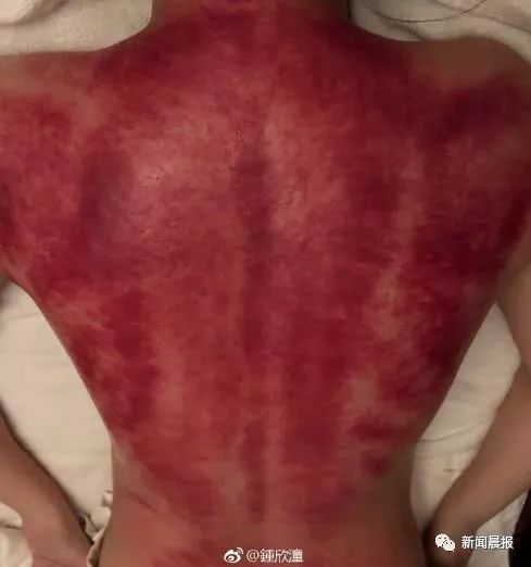 Caution: A Male Celebrity's Bare Back Photo Startles Netizens - Important Tips for Gua Sha This Summer
