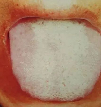 Comprehensive Guide to Tongue Diagnosis and Associated Conditions in TCM