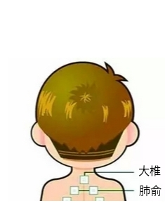 Prevention and Treatment of Exogenous Fever in Children According to Traditional Chinese Medicine