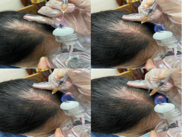 Essential Knowledge of Fire Needle Therapy in Dermatology