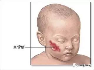 Two Powders for Hemangiomas