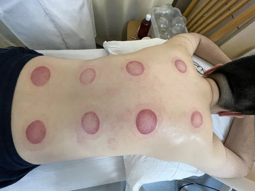 Traditional Techniques for Eliminating Dampness and Detoxification