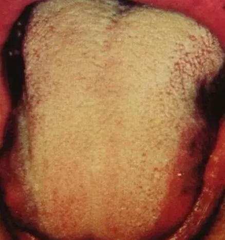Comprehensive Guide to Tongue Diagnosis and Associated Conditions in TCM
