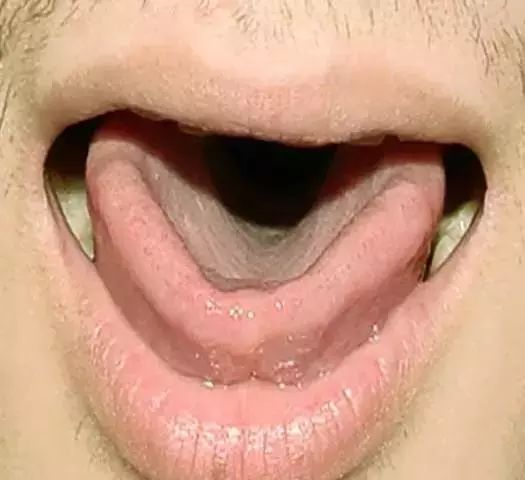 The Most Comprehensive Guide to Tongue Diagnosis! Master It and Become a Tongue Diagnosis Expert