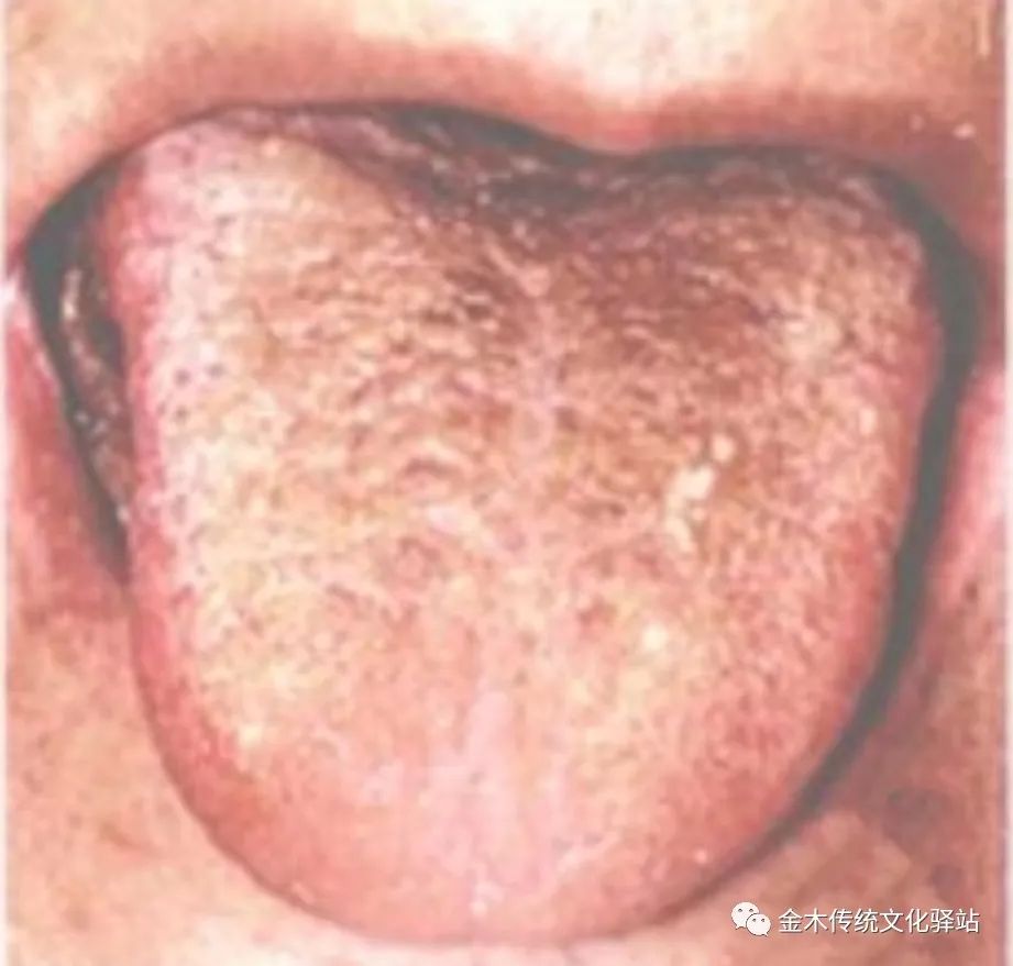 Tongue Diagnosis in Traditional Chinese Medicine: Tongue Coating