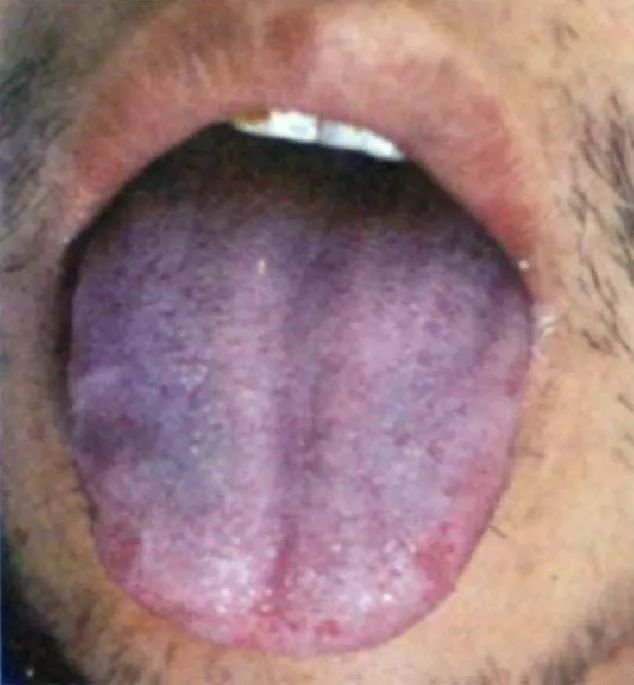 Understanding Health Through Tongue Diagnosis in Traditional Chinese Medicine