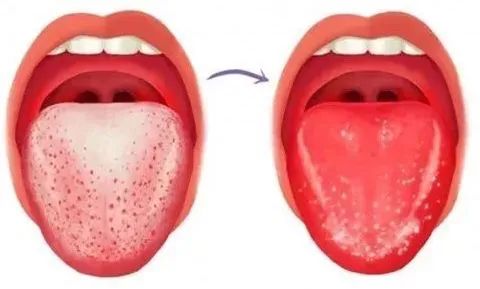 Observing Tongue Coating to Predict Diseases