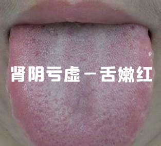 Distinguishing and Treating Kidney Yang Deficiency, Kidney Yin Deficiency, and Kidney Essence Deficiency