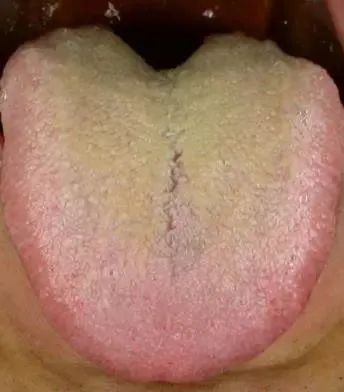 Why Do Kidney Yang Deficiency Remedies Seem Ineffective?