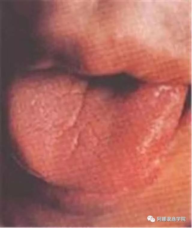 A Comprehensive Guide to 22 High-Definition Tongue Diagnosis Images: Understand Diseases Through Tongue Observation!