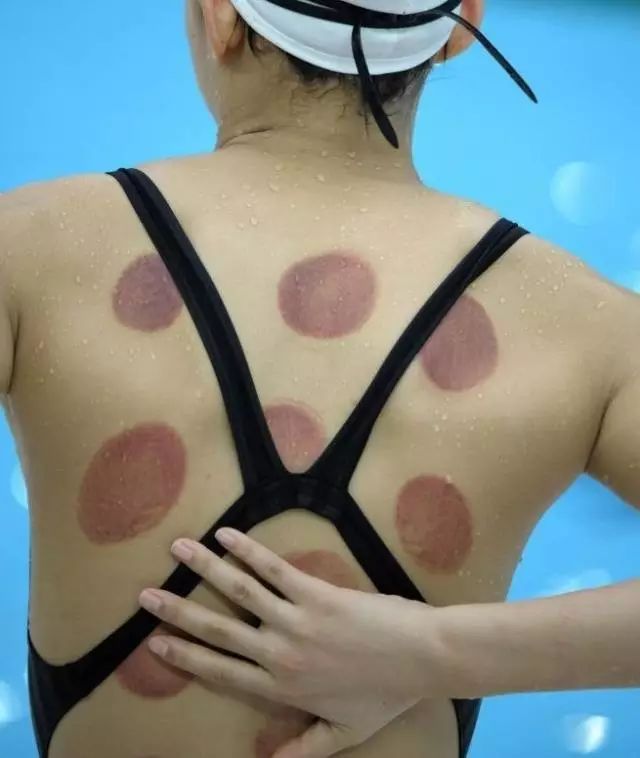 Man Gets Stuck in Cupping Therapy! Firefighters Called for Rescue... Would You Dare to Try It?
