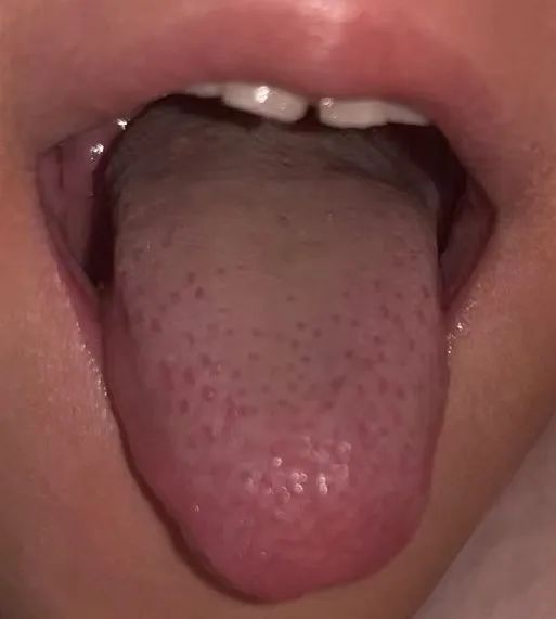 Symptoms Indicating Progression Beyond Simple Exterior Syndrome in Exogenous Diseases