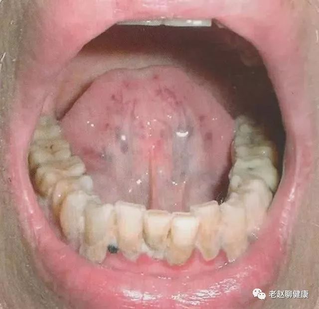 Tongue Diagnosis │ Sublingual Collaterals