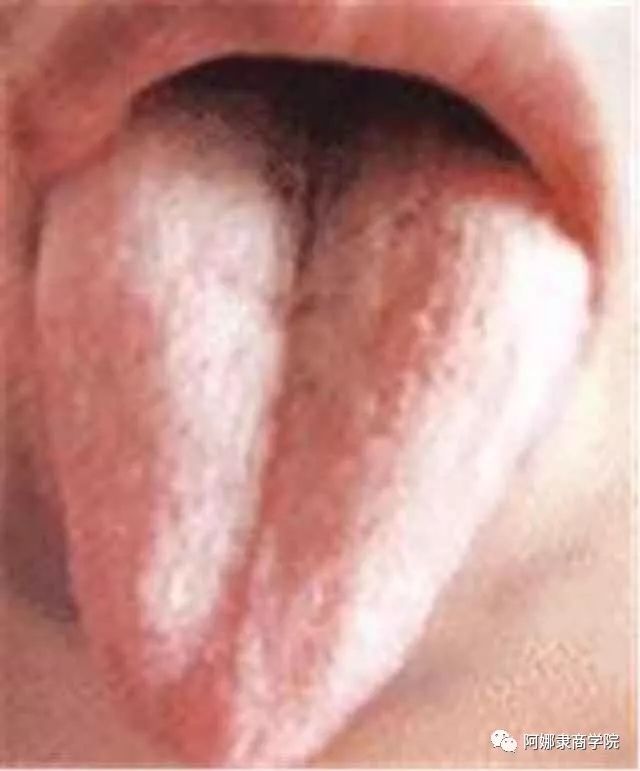 A Comprehensive Guide to 22 High-Definition Tongue Diagnosis Images: Understand Diseases Through Tongue Observation!