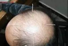 The Miraculous "Three Needles" in TCM Acupuncture: Treating One Disease with Three Acupuncture Points