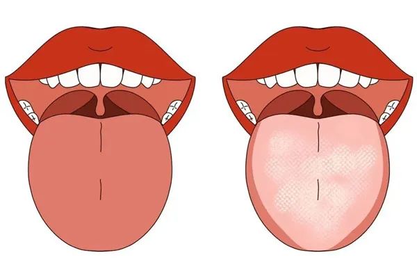 Observing the Tongue in Traditional Chinese Medicine: Tongue Color Changes Indicate Stroke!