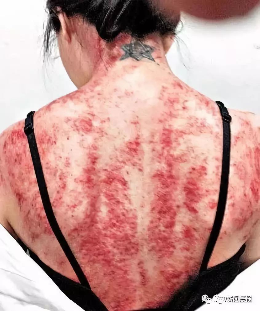 Caution: A Male Celebrity's Bare Back Photo Startles Netizens - Important Tips for Gua Sha This Summer