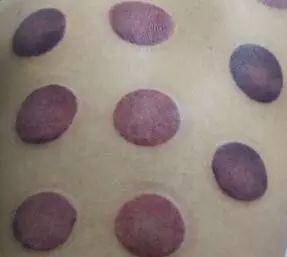 A Comprehensive Guide to Cupping Therapy