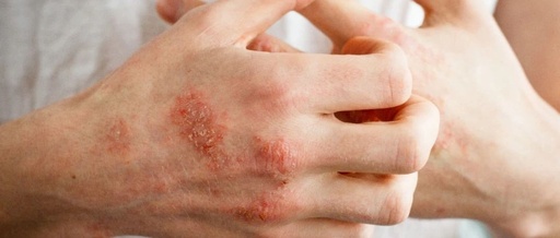 Health: Hot and Humid Weather Brings Eczema to Its Peak! Here Are Several Treatment and Management Methods to Keep Handy!