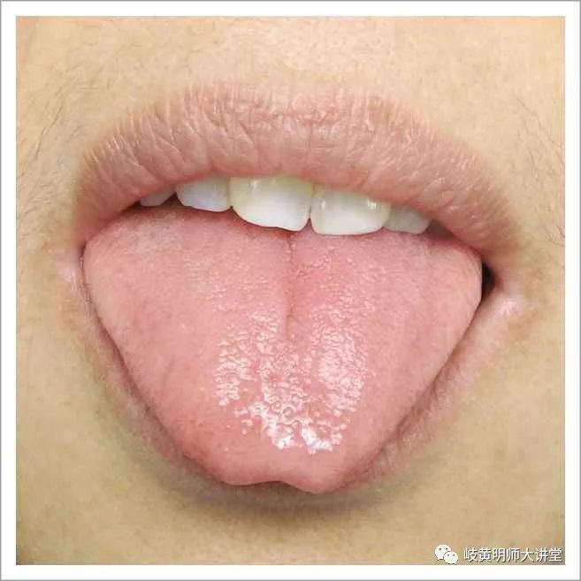 Traditional Chinese Medicine Tongue Diagnosis: Illustrated Guide to 14 Types of Tongue Shapes and Qualities