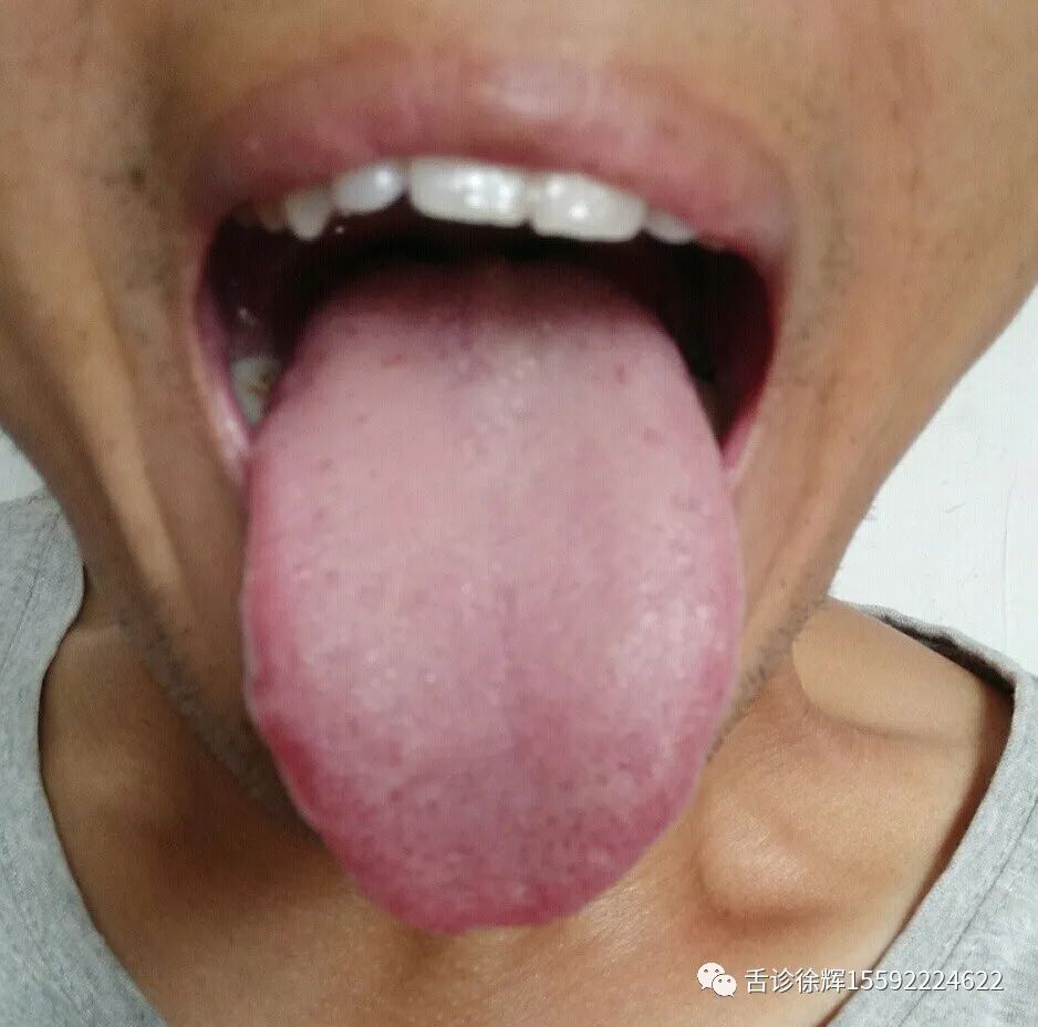Analysis of Tongue Appearance: Discussing the Reasons for Variations in Tongue Shape and Color at Different Times