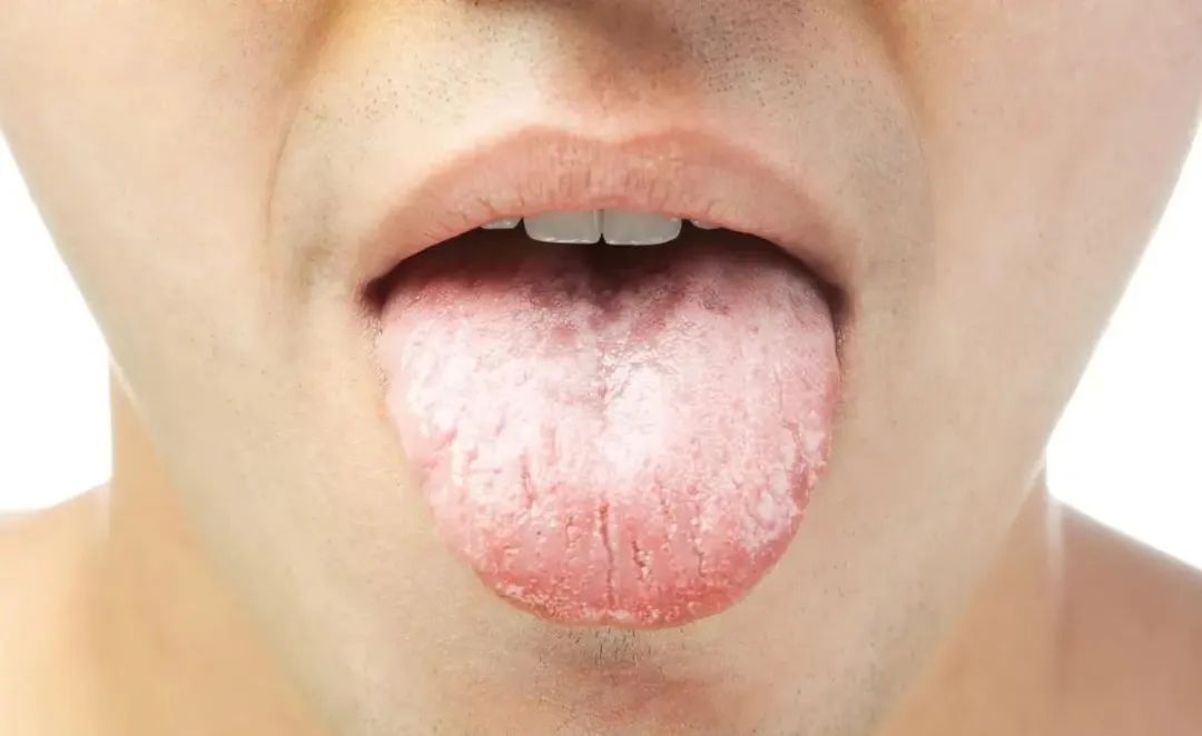 Traditional Chinese Medicine Tongue Diagnosis: What Different Tongue Appearances Indicate