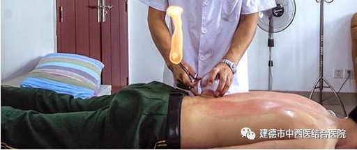 Cupping Therapy in Summer: An Effective Method to Eliminate Dampness, Relieve Heat, and Drive Away Cold