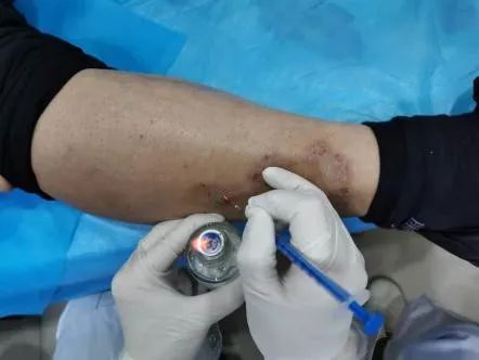 Fire Needle Therapy for Treating Neurodermatitis