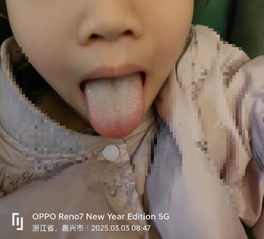 Don't Just Rely on Tongue Coating to Assess Health! There's More to It