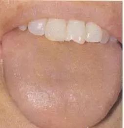 Understanding Tongue Diagnosis in Traditional Chinese Medicine (with Tongue Diagnosis Illustrations)