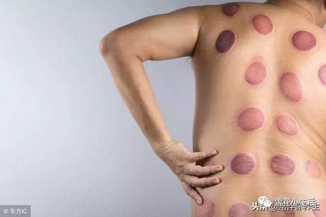 Is Cupping Good? TCM and Western Medicine Warn: This Way of Cupping Could Shorten Your Life, Please Be Aware!