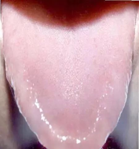 Tongue Diagnosis - Illustrated Guide to Tongue Manifestations